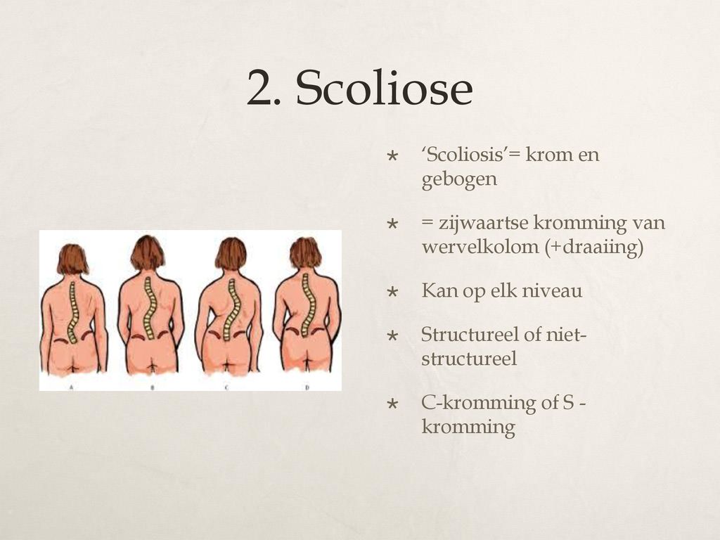 2. Scoliose ‘Scoliosis’= krom en gebogen