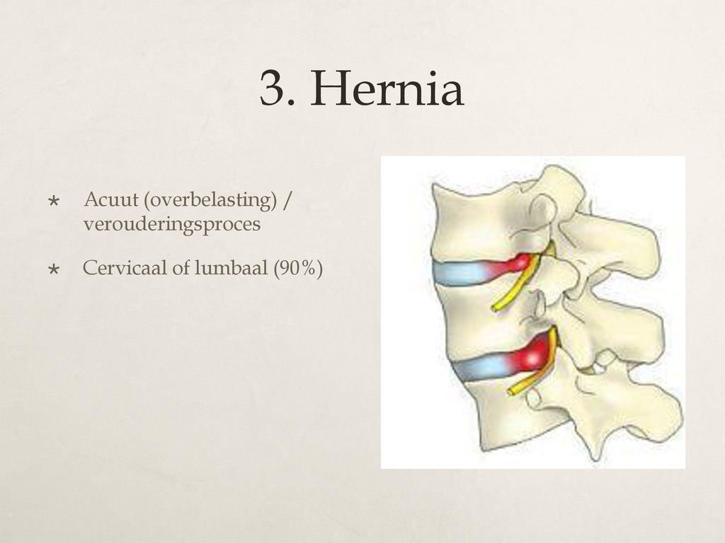 3. Hernia Acuut (overbelasting) / verouderingsproces