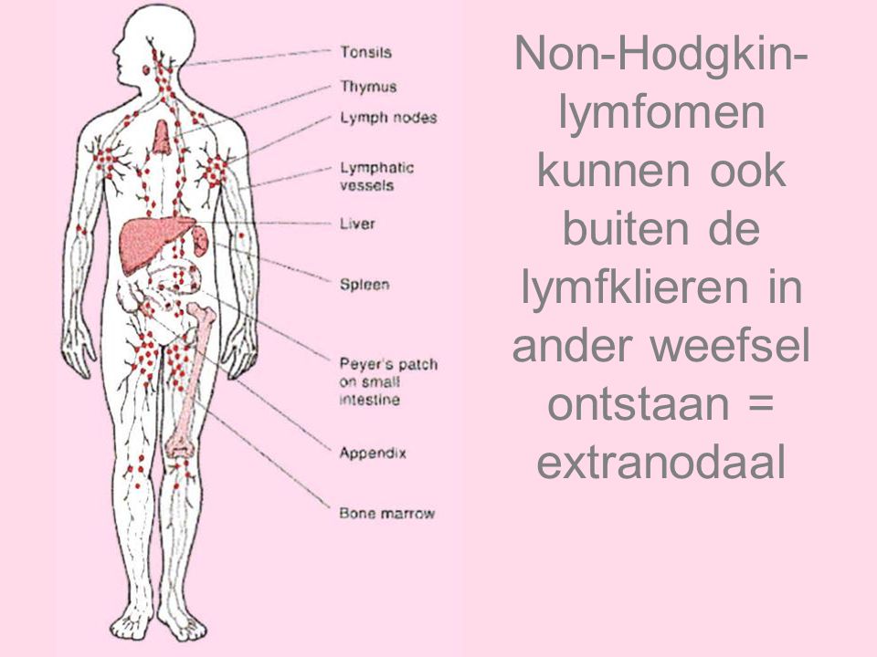 Non-Hodgkin- lymfomen kunnen ook buiten de lymfklieren in ander weefsel ontstaan = extranodaal