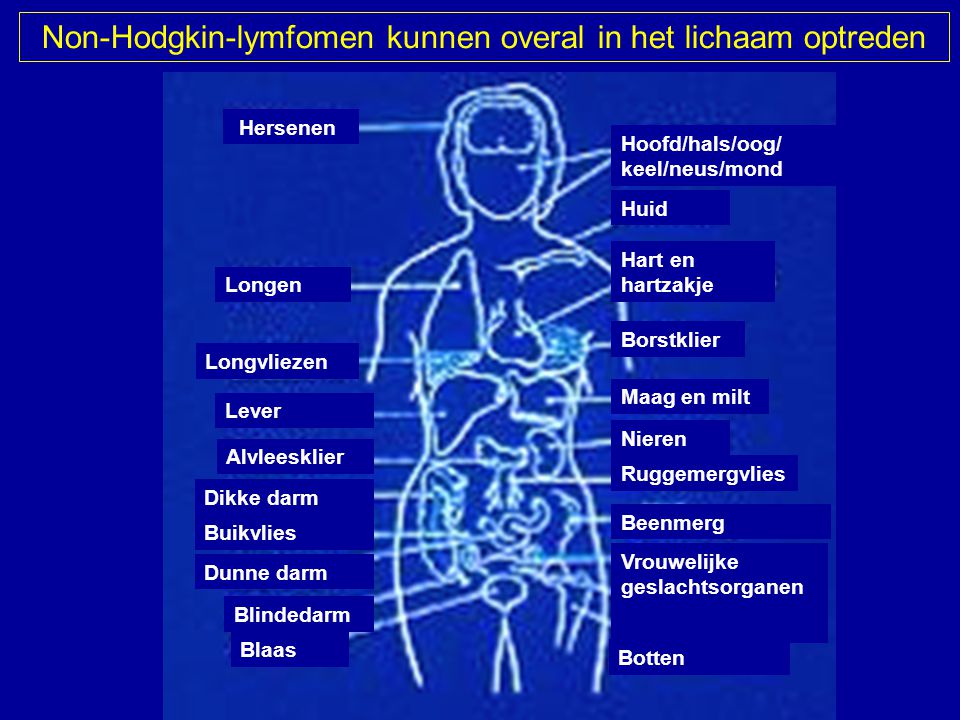 Non-Hodgkin-lymfomen kunnen overal in het lichaam optreden