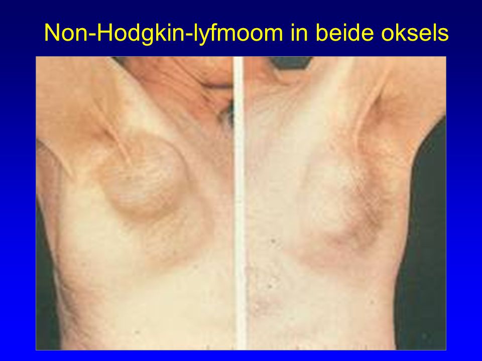 Non-Hodgkin-lyfmoom in beide oksels