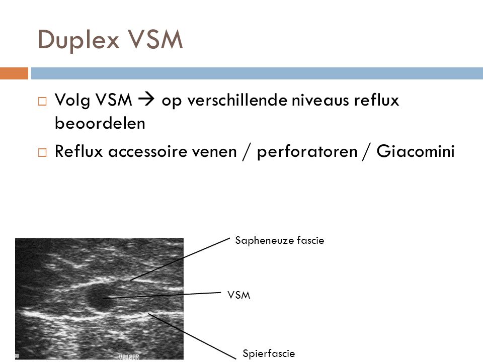Duplex VSM Volg VSM  op verschillende niveaus reflux beoordelen