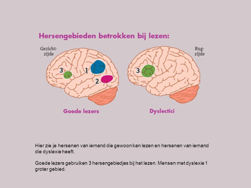 Hier zie je hersenen van iemand die gewoon kan lezen en hersenen van iemand die dyslexie heeft.