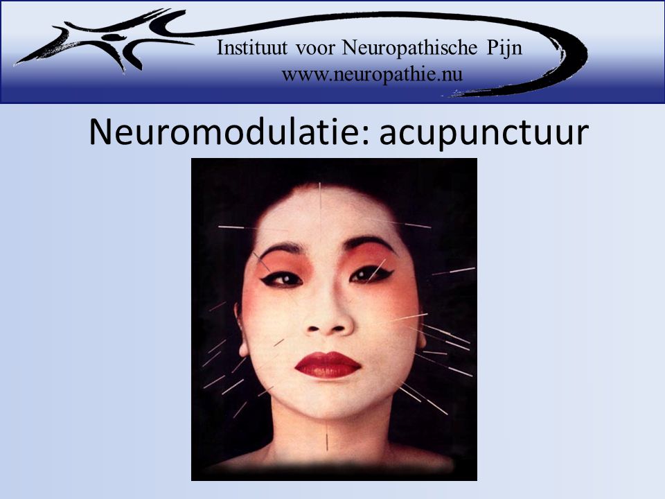 Neuromodulatie: acupunctuur