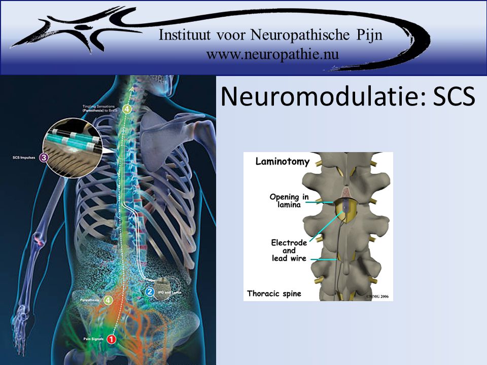 Neuromodulatie: SCS