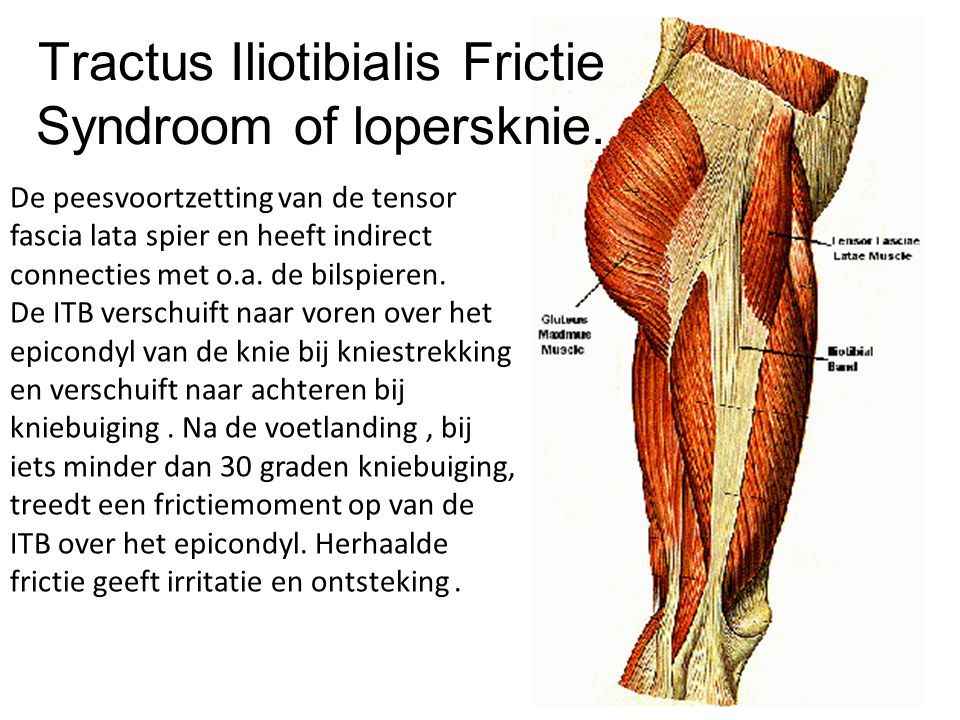 Tractus Iliotibialis Frictie Syndroom of lopersknie.