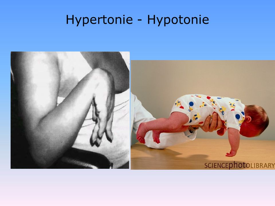 Hypertonie - Hypotonie