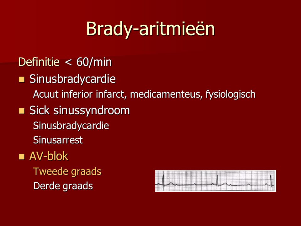 Brady-aritmieën Definitie < 60/min Sinusbradycardie