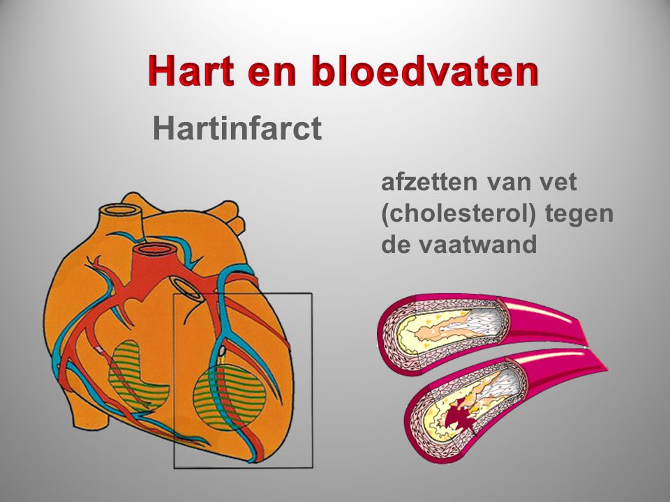 Hart en bloedvaten Hartinfarct