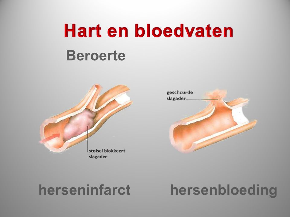 Hart en bloedvaten Beroerte herseninfarct hersenbloeding