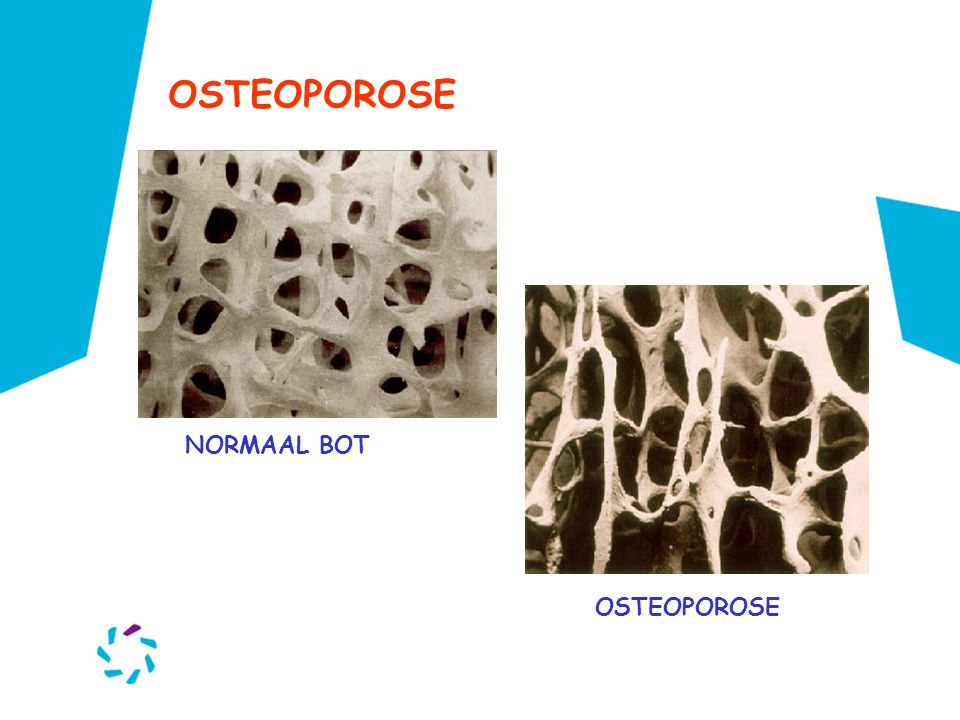 OSTEOPOROSE NORMAAL BOT OSTEOPOROSE