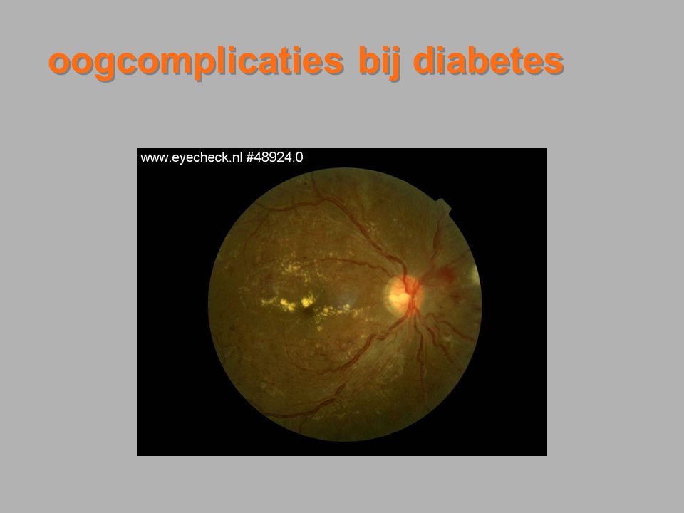 oogcomplicaties bij diabetes