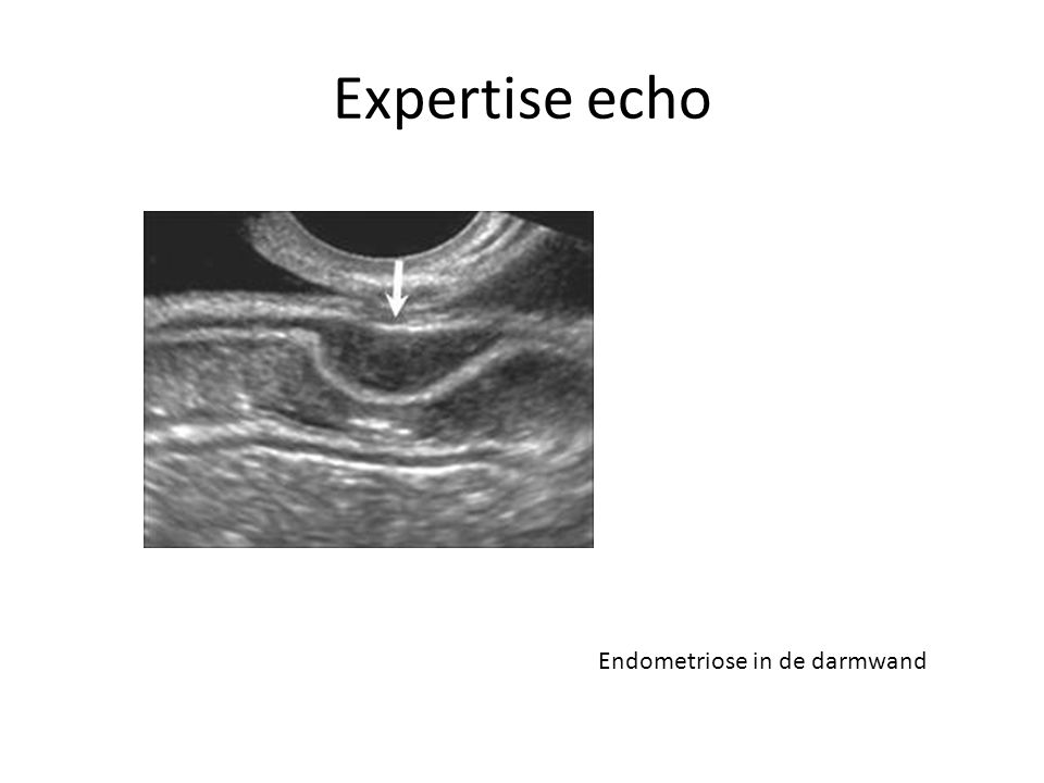 Expertise echo Endometriose in de darmwand