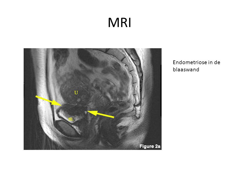 MRI Endometriose in de blaaswand