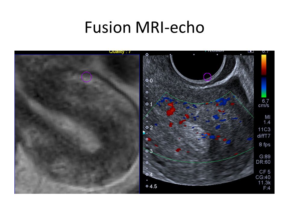Fusion MRI-echo