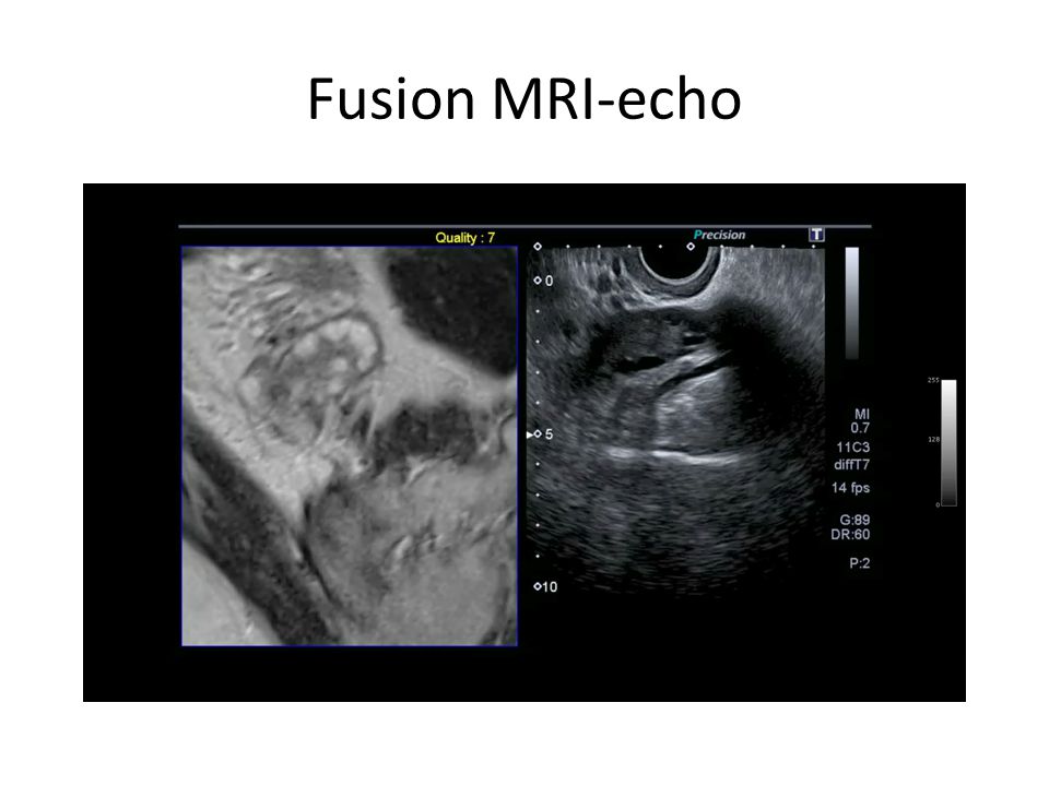 Fusion MRI-echo