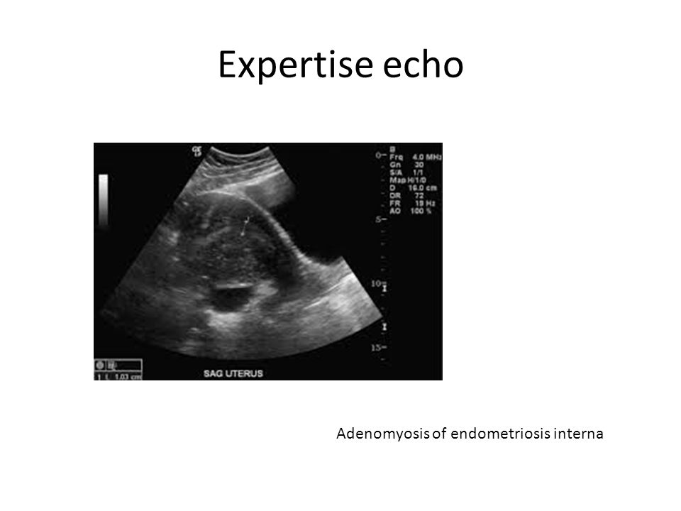 Expertise echo Adenomyosis of endometriosis interna