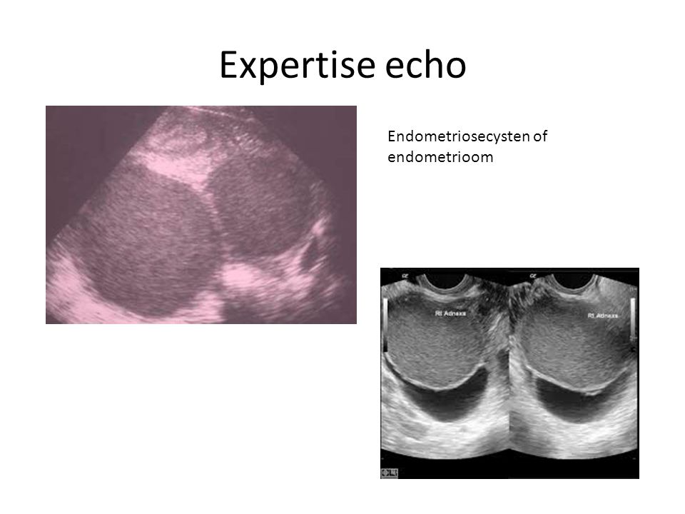 Expertise echo Endometriosecysten of endometrioom
