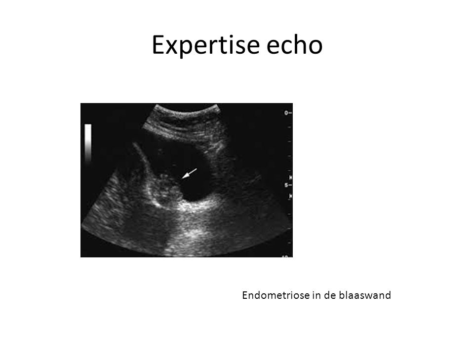 Expertise echo Endometriose in de blaaswand