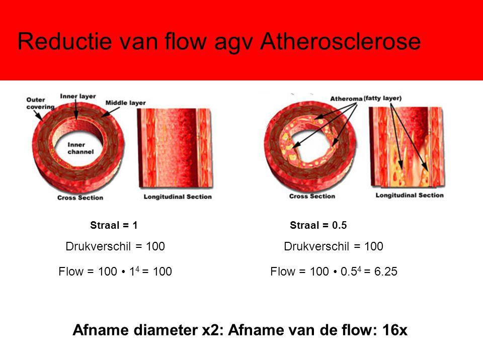 Reductie van flow agv Atherosclerose