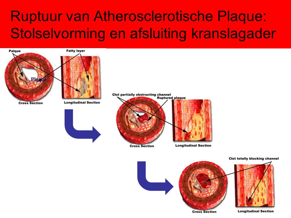 Ruptuur van Atherosclerotische Plaque: Stolselvorming en afsluiting kranslagader