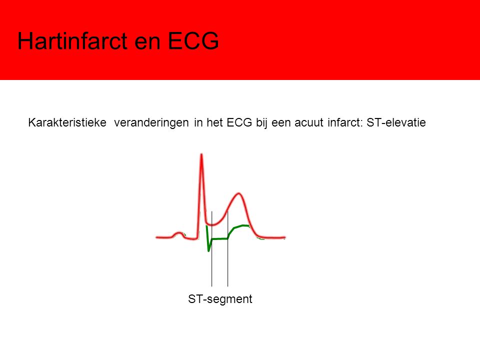 Hartinfarct en ECG Karakteristieke veranderingen in het ECG bij een acuut infarct: ST-elevatie.