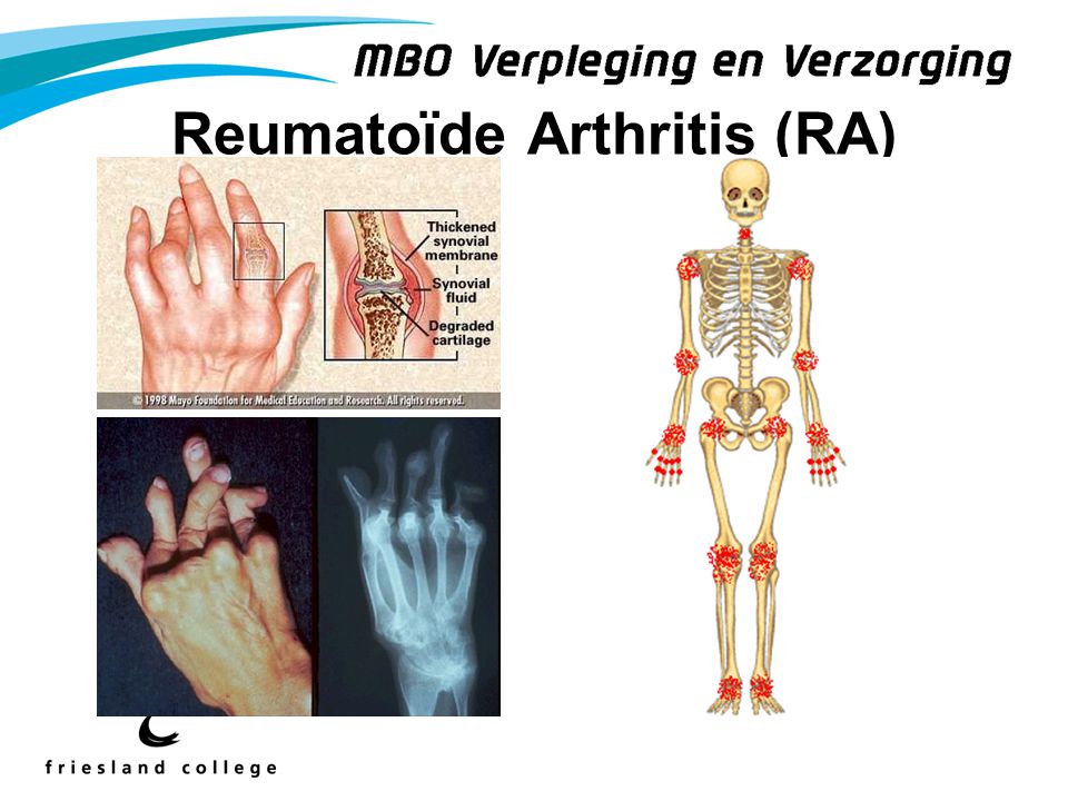 Reumatoïde Arthritis (RA)