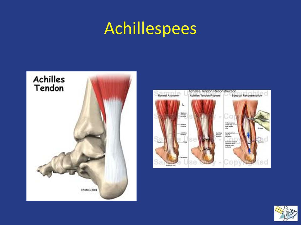 Achillespees