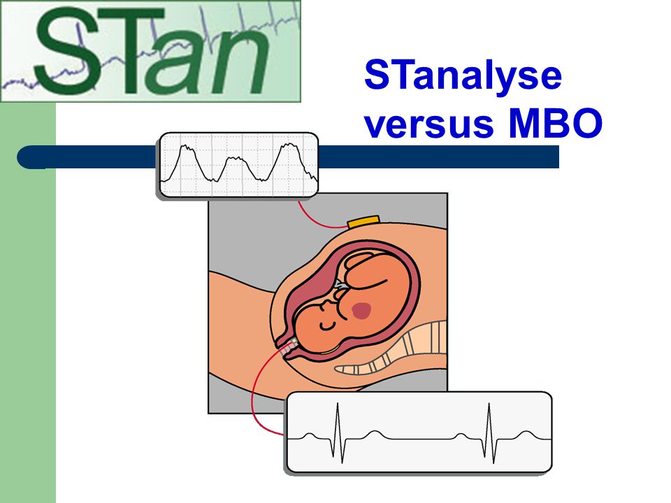STanalyse versus MBO