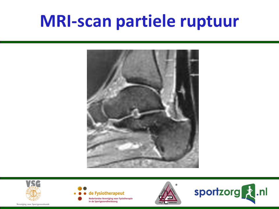 MRI-scan partiele ruptuur