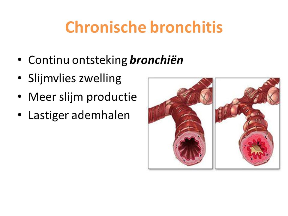 Chronische bronchitis