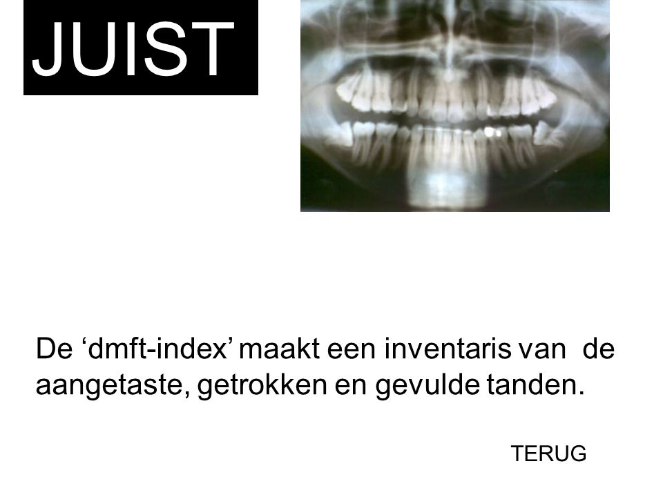 JUIST De ‘dmft-index’ maakt een inventaris van de aangetaste, getrokken en gevulde tanden. TERUG