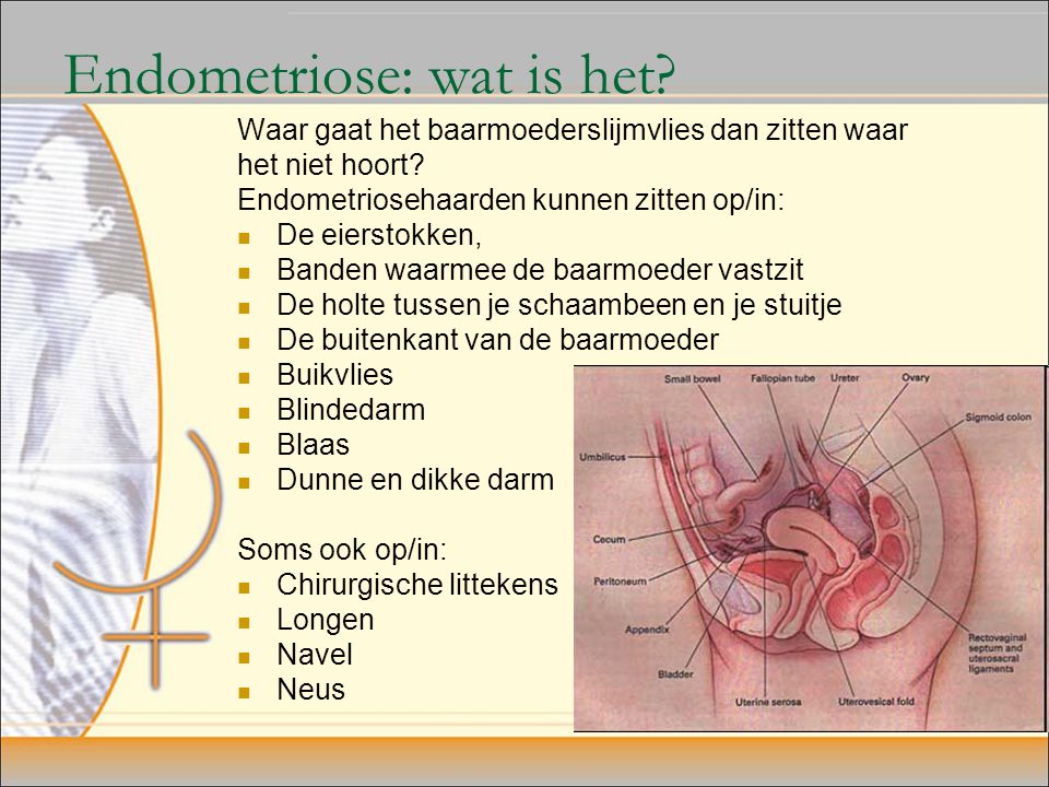 Endometriose: wat is het