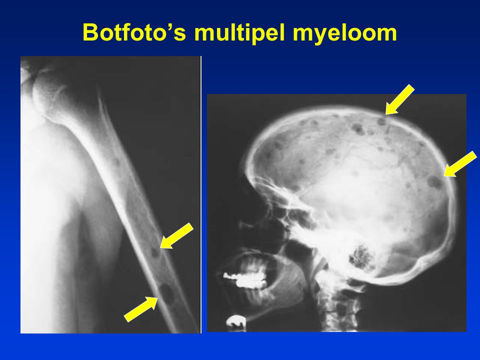 Botfoto’s multipel myeloom