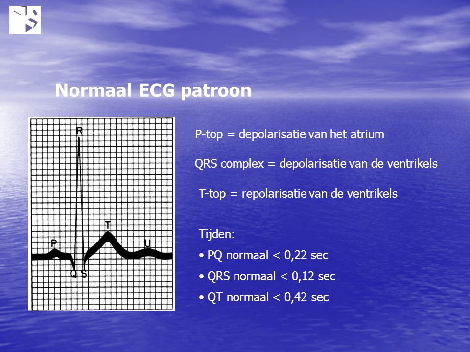 Normaal ECG patroon P-top = depolarisatie van het atrium