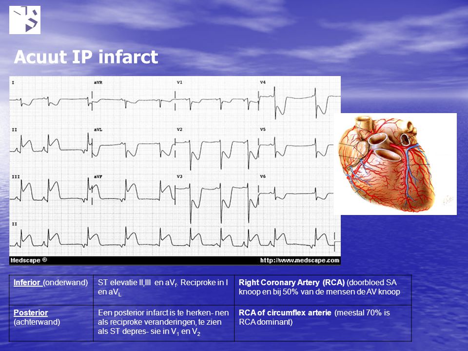Acuut IP infarct Inferior (onderwand)