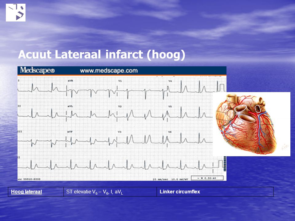 Acuut Lateraal infarct (hoog)