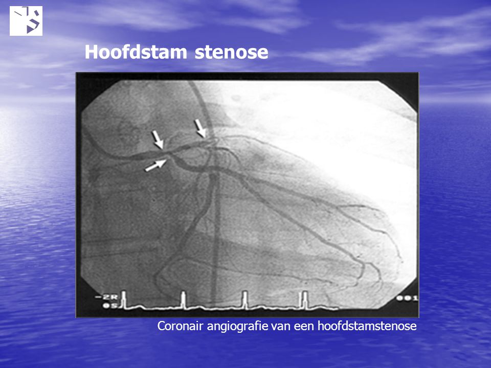 Hoofdstam stenose Coronair angiografie van een hoofdstamstenose