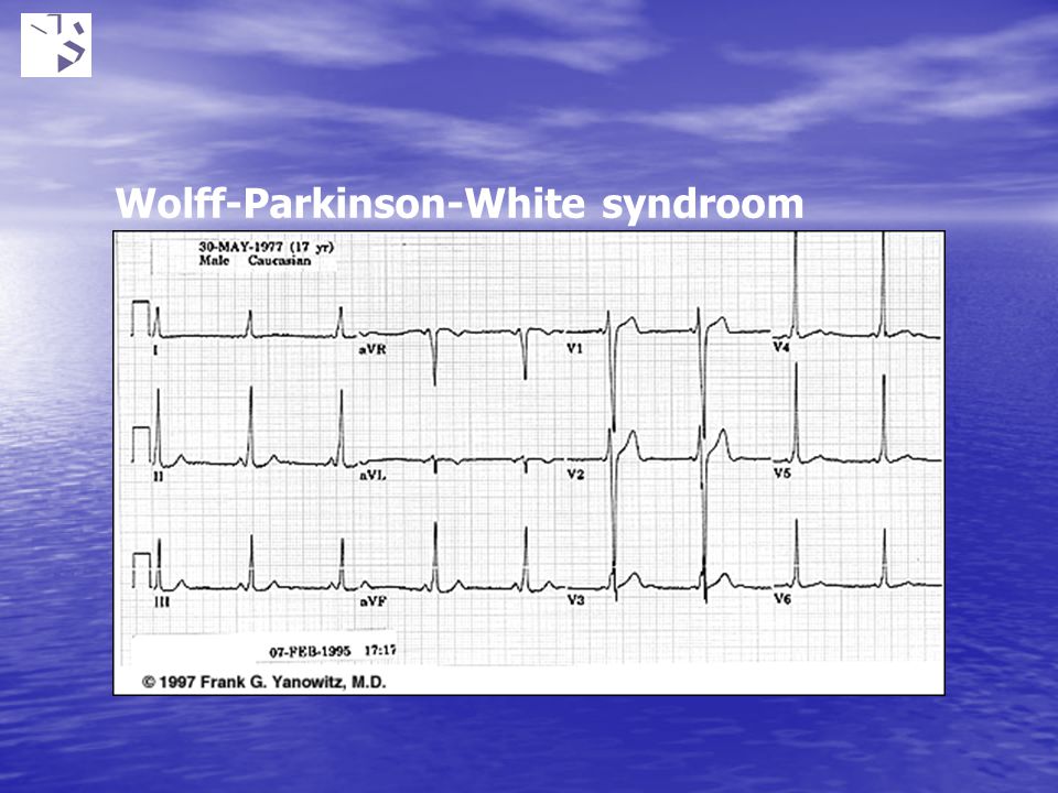 Wolff-Parkinson-White syndroom