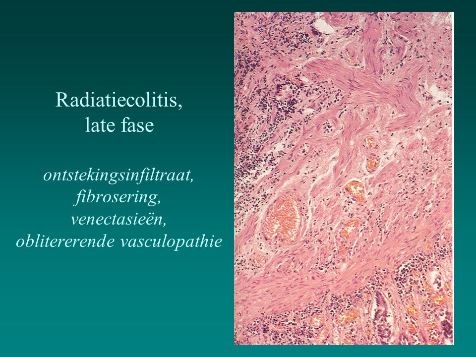 Radiatiecolitis, late fase ontstekingsinfiltraat, fibrosering, venectasieën, oblitererende vasculopathie