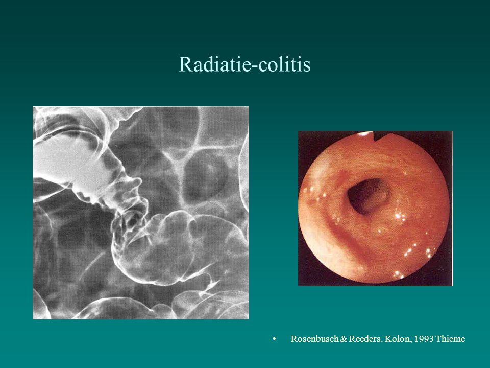 Radiatie-colitis Rosenbusch & Reeders. Kolon, 1993 Thieme