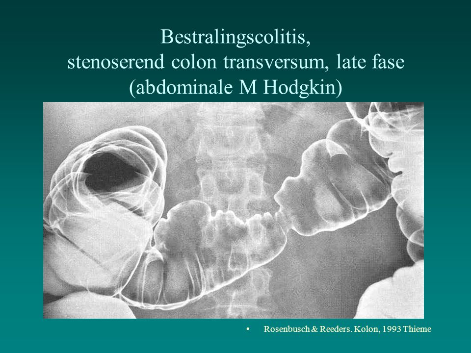 Bestralingscolitis, stenoserend colon transversum, late fase (abdominale M Hodgkin)