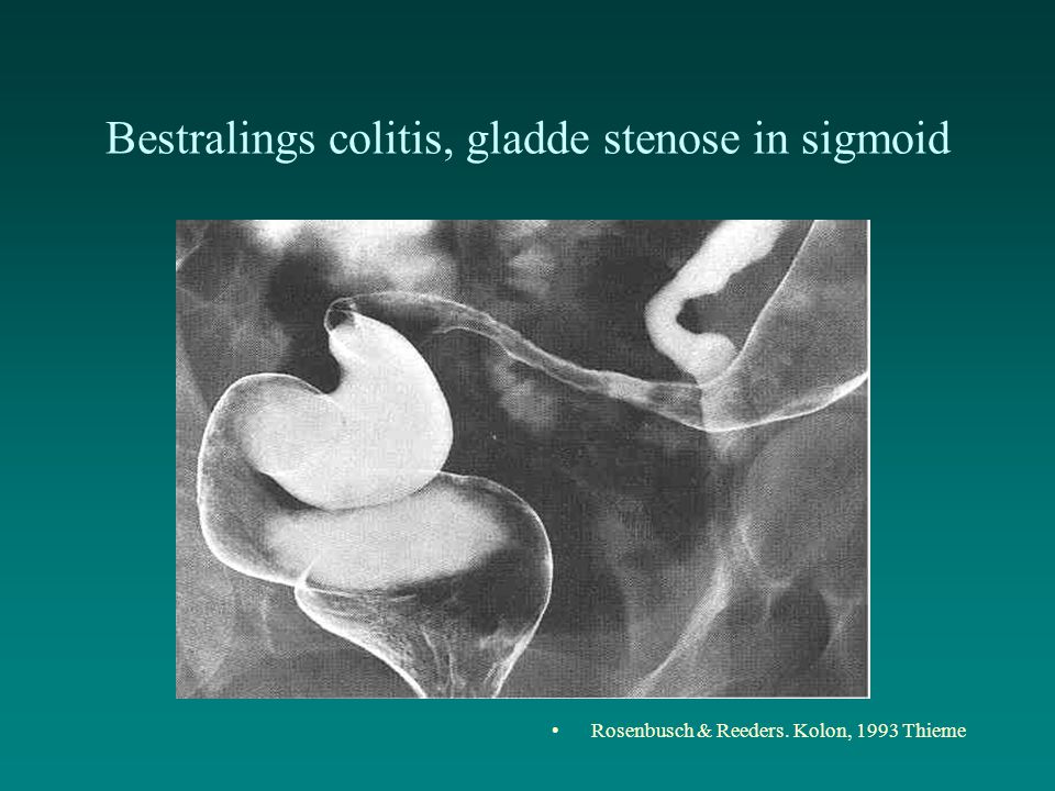 Bestralings colitis, gladde stenose in sigmoid