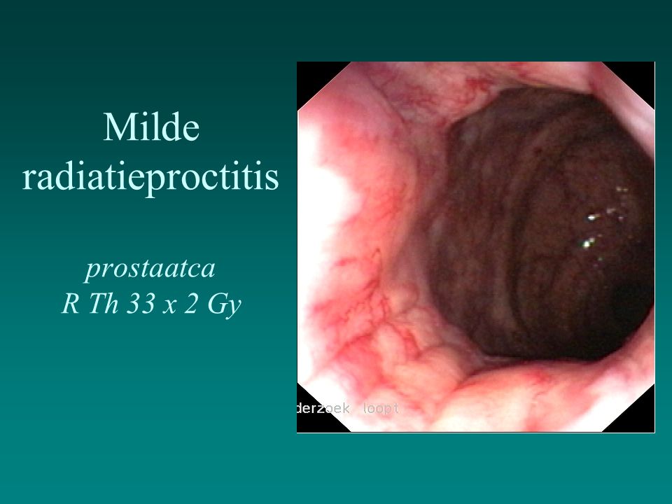 Milde radiatieproctitis prostaatca R Th 33 x 2 Gy
