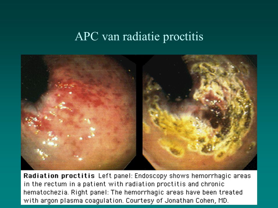 APC van radiatie proctitis