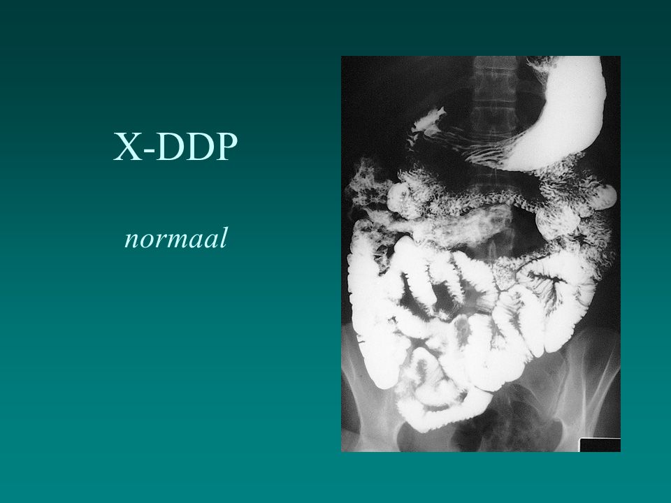 X-DDP normaal