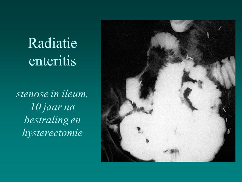 Radiatie enteritis stenose in ileum, 10 jaar na bestraling en hysterectomie