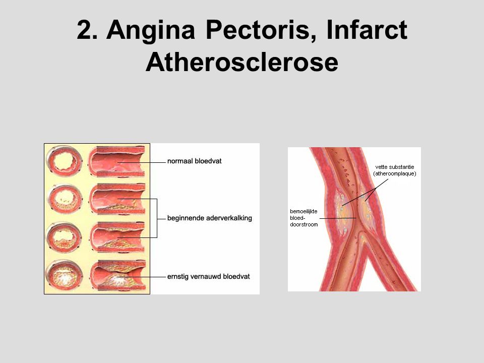 2. Angina Pectoris, Infarct Atherosclerose