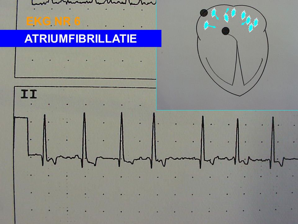 EKG NR 6 ATRIUMFIBRILLATIE