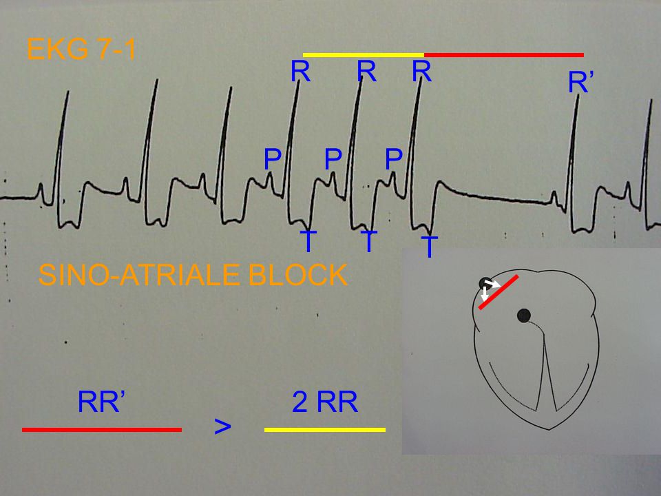 EKG 7-1 R R R R’ P P P T T T SINO-ATRIALE BLOCK RR’ 2 RR >